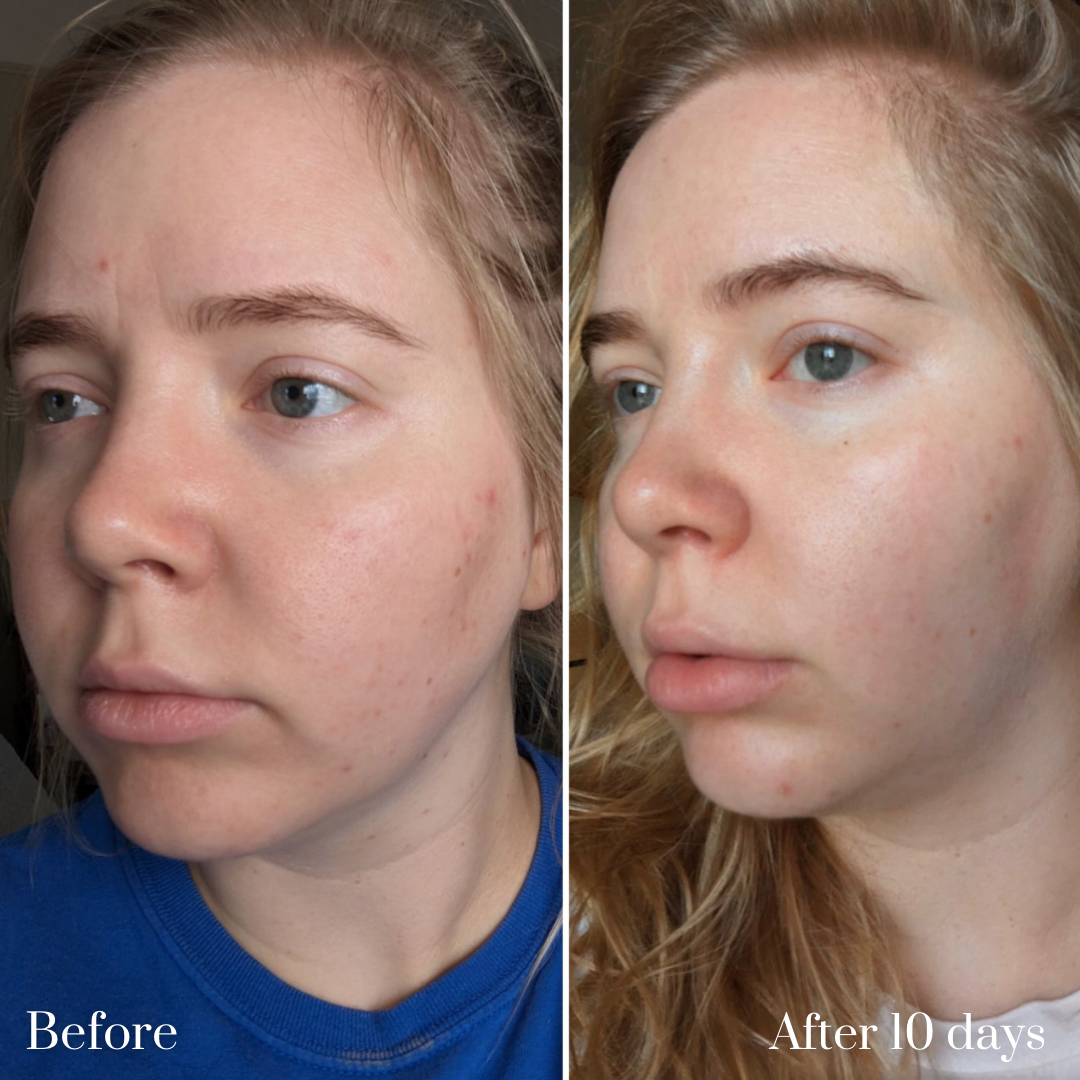 Before and after side by side view of woman's face after using Barrier Plus Pigment Potion